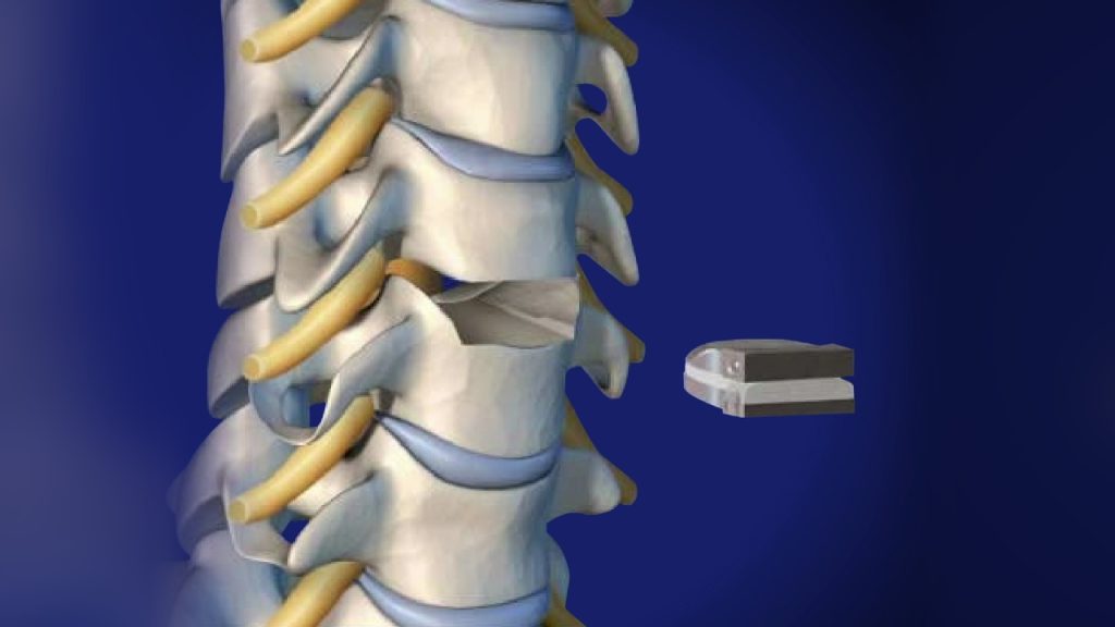 Spinal Disc Replacement