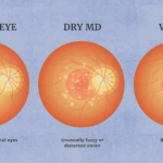 Importance of Proper Treatment for Dry AMD