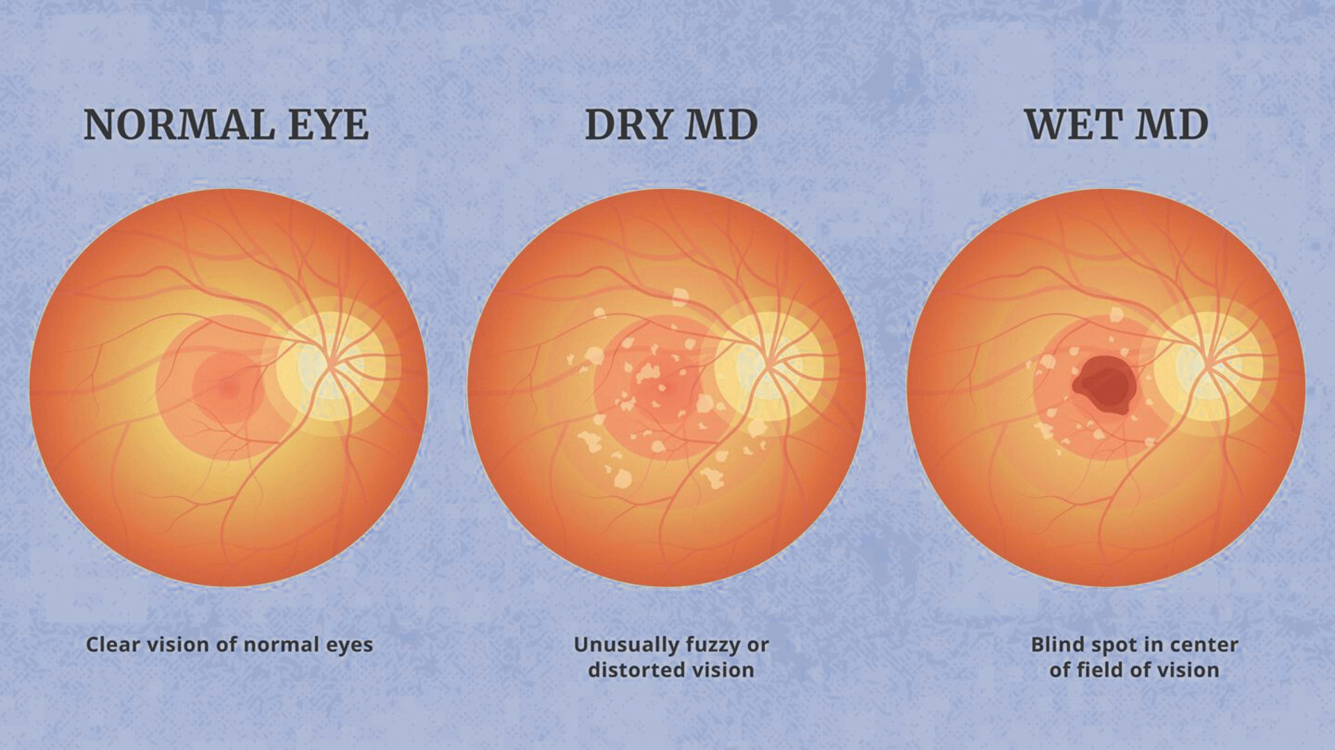 Importance of Proper Treatment for Dry AMD